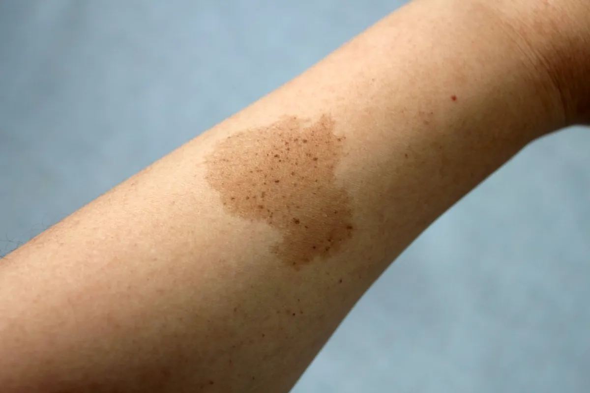 Marca de nacimiento en el brazo de una persona. | Foto: Shutterstock